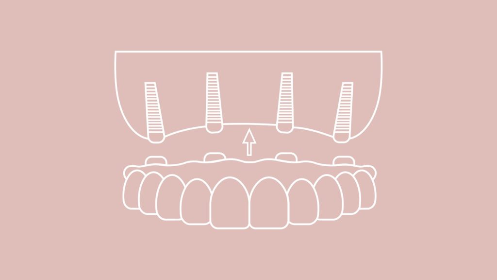 all on 4 implant icon
