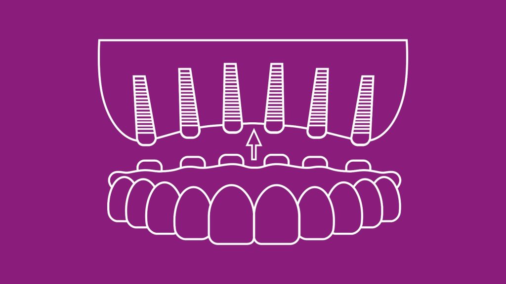 all on 6 implant icon