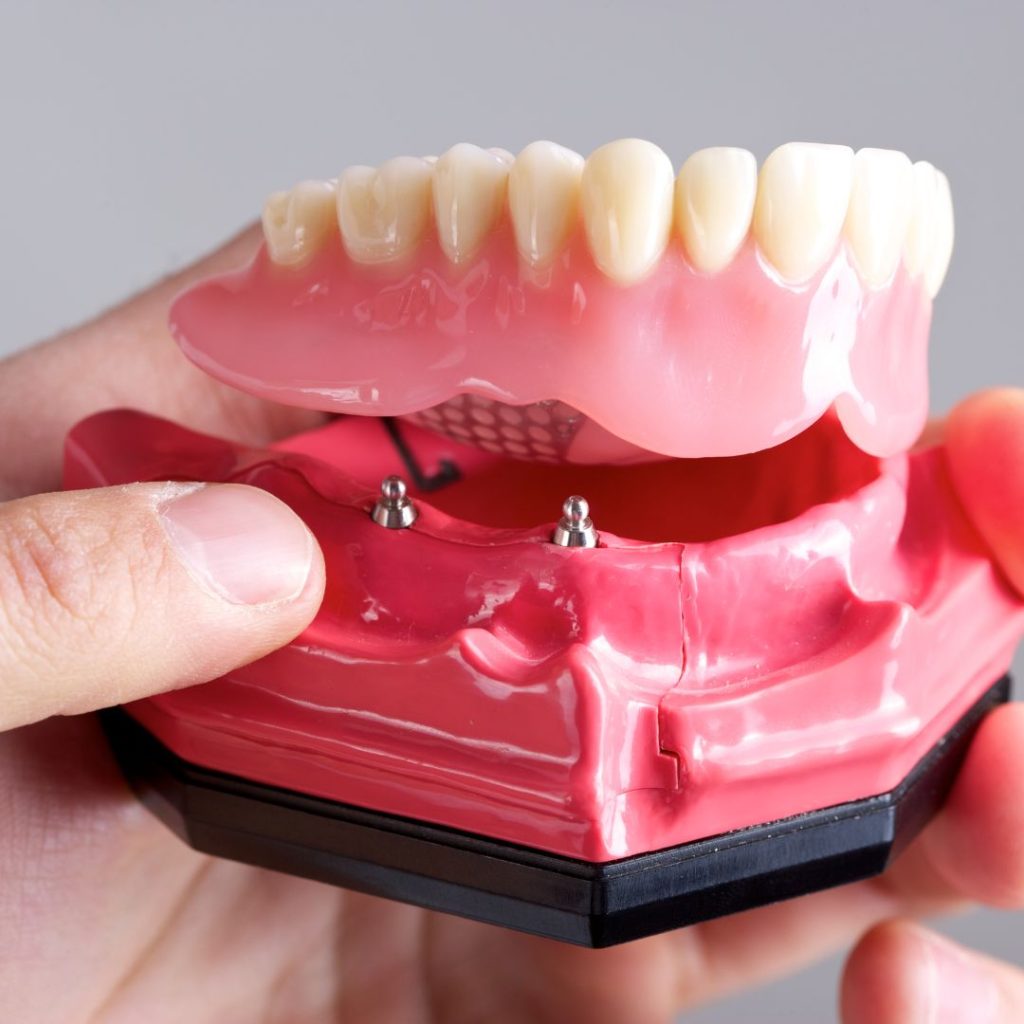 benefits of denture implants