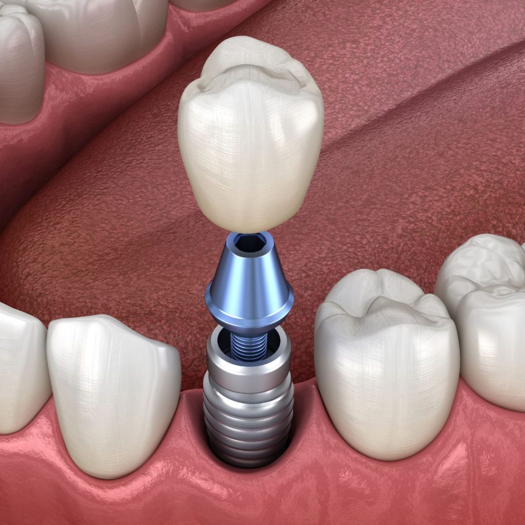 single dental implants