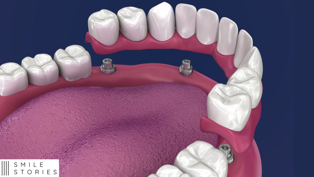 mock up of a bottom jaw with 10 teeth in the air and 4 implants in jaw