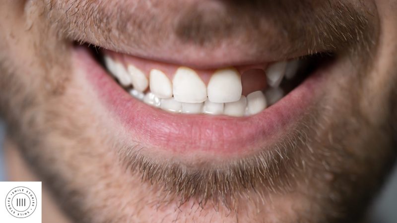 The jaw of a white male, with stubble. His right side front tooth is missing
