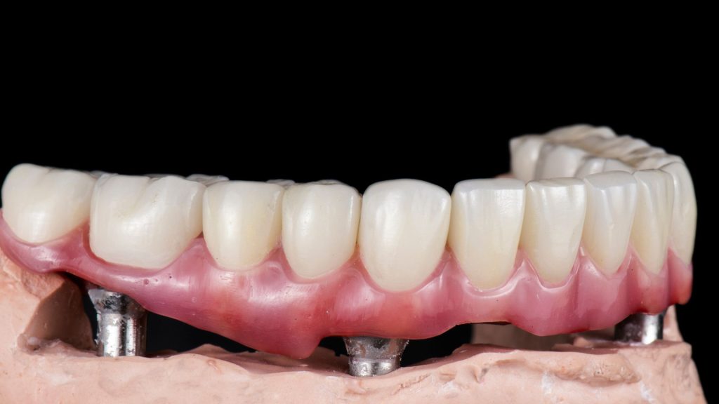 all-on-6-dental-implants