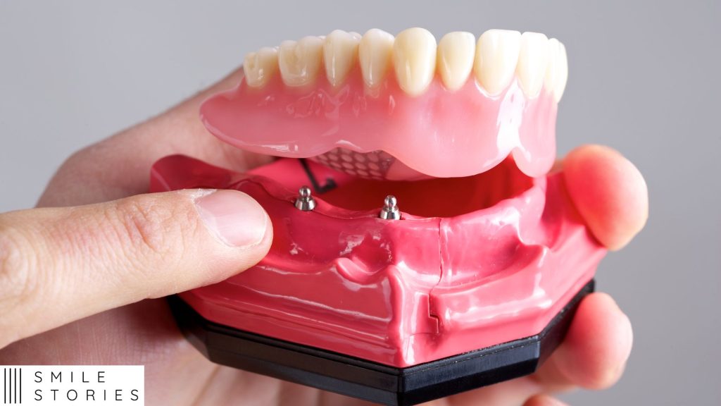 a set of denture implants being held in a hand over a mock up of a bottom jaw