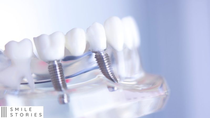 Talking freely with multiple implants