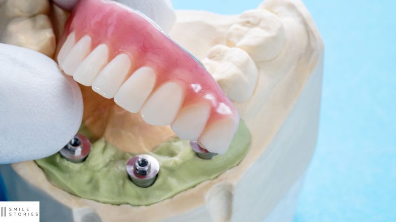A top set of implants with a model of a bottom jaw with 4 implants