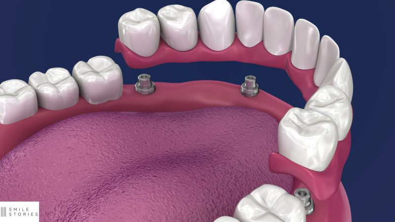 Why All on 4 Dental Implants Are Popular in Winchester image