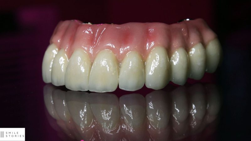 top set pf denture implants in Weymouth