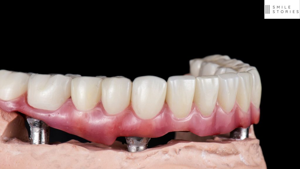 a mock up of a bottom jaw with an all on 4 dental implant