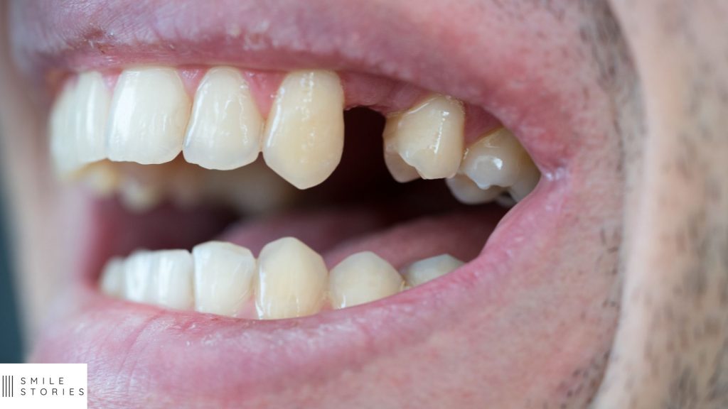 a close up of someone's mouth with a missing tooth. the top right premolar is missing