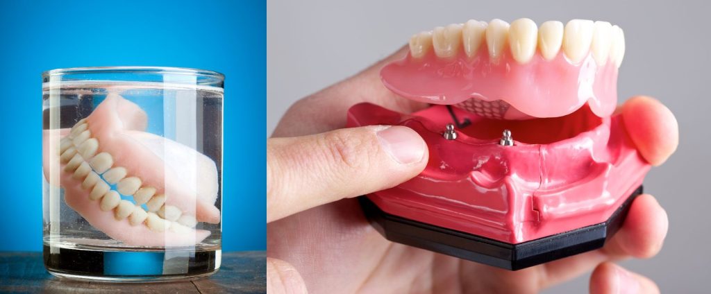 denture implants vs traditional dentures