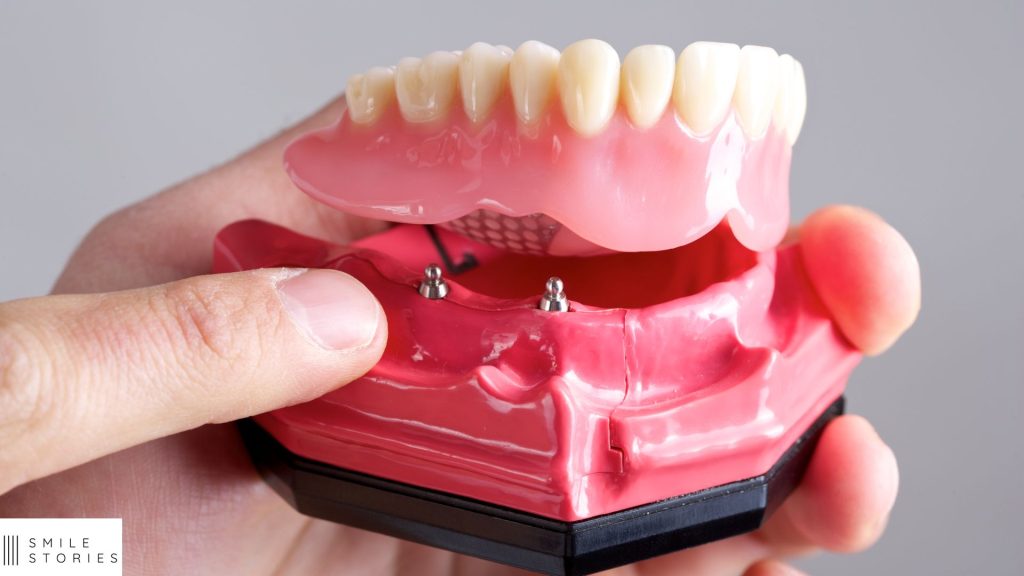 a mock up of a bottom set of denture implants being held in a hand