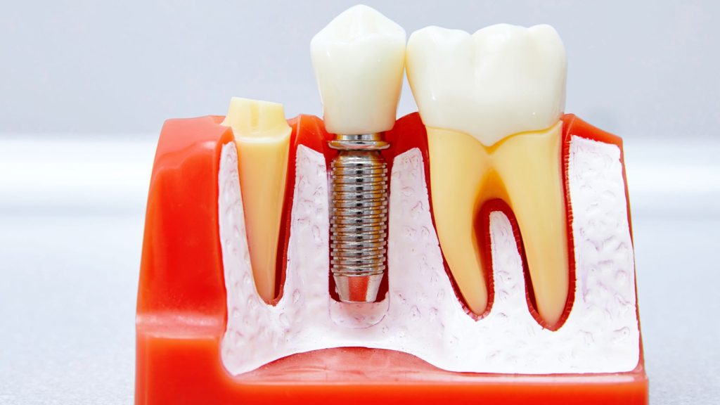 mock up of a single dental implant in-between a premolar and an incisor
