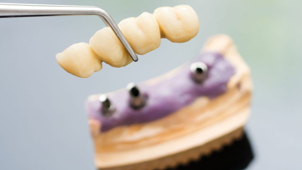 multiple dental implants Dorchester