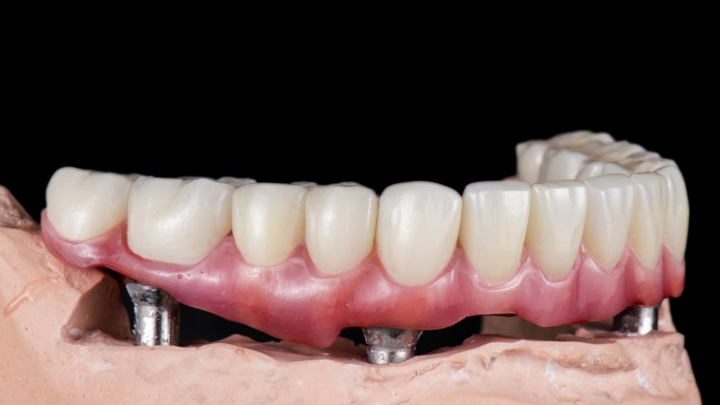 missing teeth solution Salisbury - denture retained implant