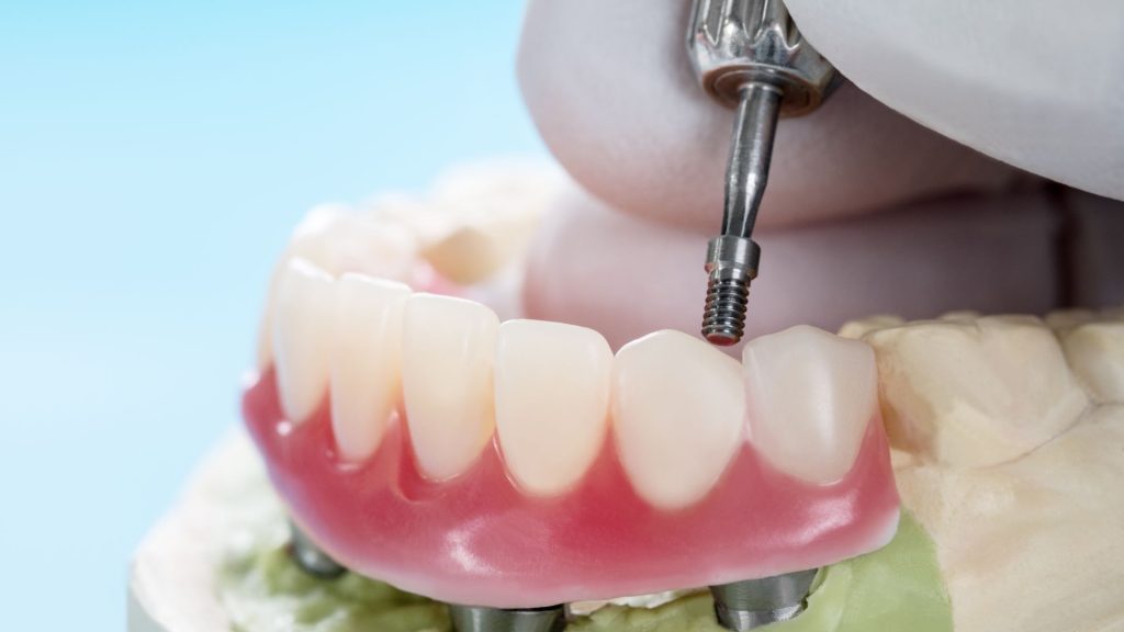 Mock-up of Denture Implants