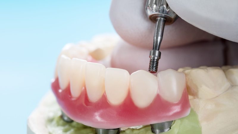Mock-up of Denture Implants