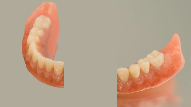 broken denture implant