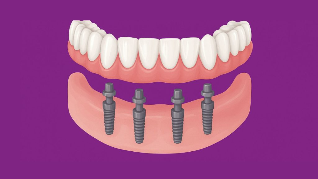 affordable all-on-4 dental implants in bournemouth