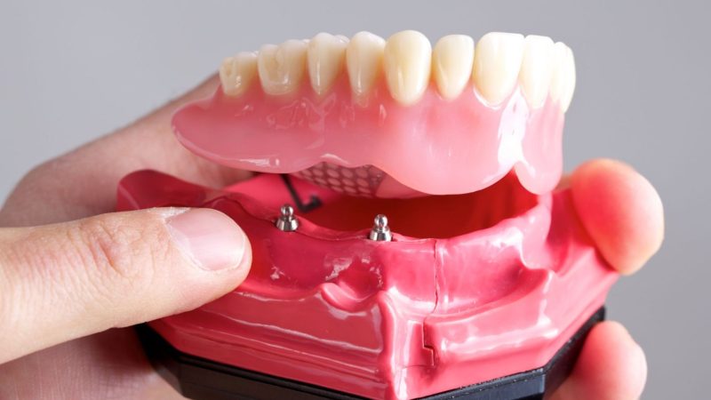 Denture Implants in Bournemouth