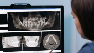 plasma rich growth factor dental implants