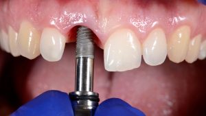 short dental implants