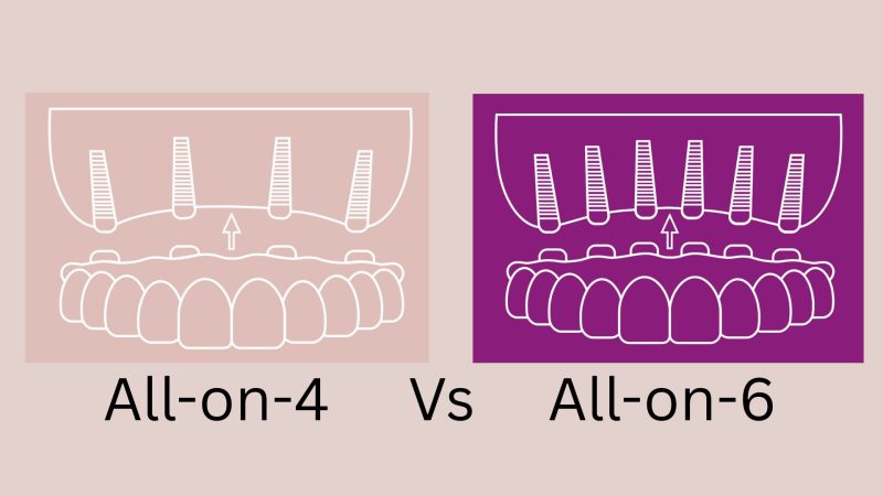 all-0n-4 vs all-on-6