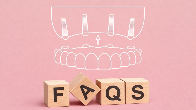 multiple dental implant faqs
