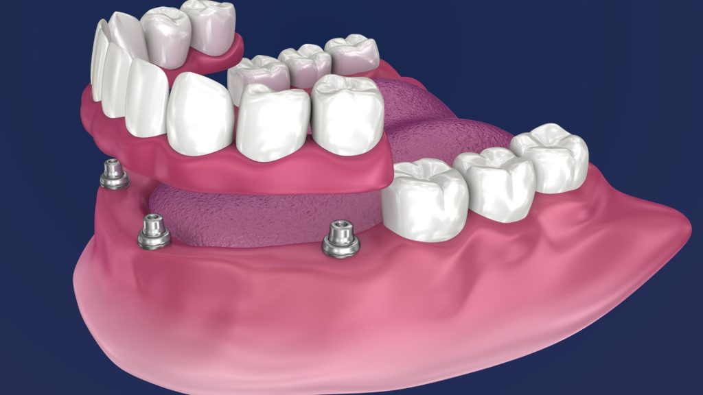 all on 4 dental implants dorset